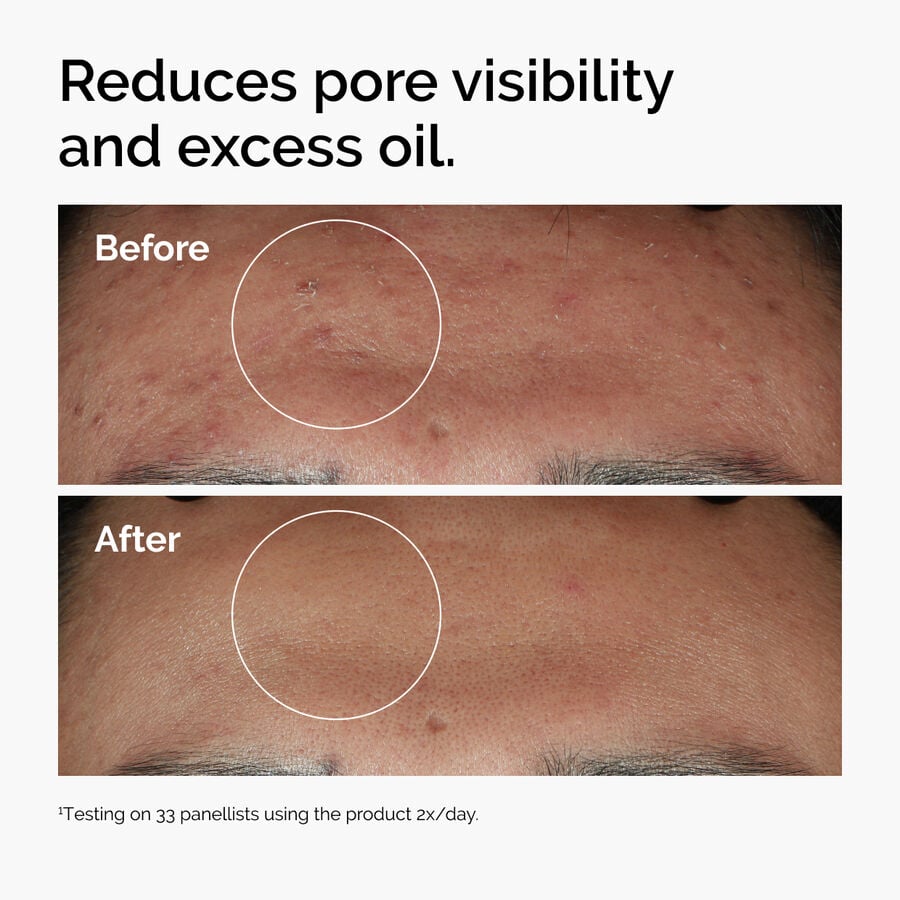 niacinamide-10-zinc-1-r4 ord-niacinamide-zinc-blemish-serum-before-after-pores.jpg