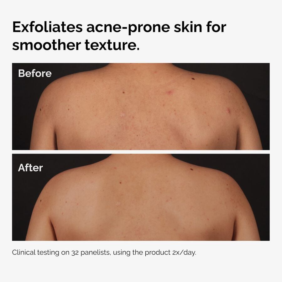 salicylic-acid-0-5-body-serum-n5 ord-salicylic-acid-body-serum-before-after-graphic-NA.jpg